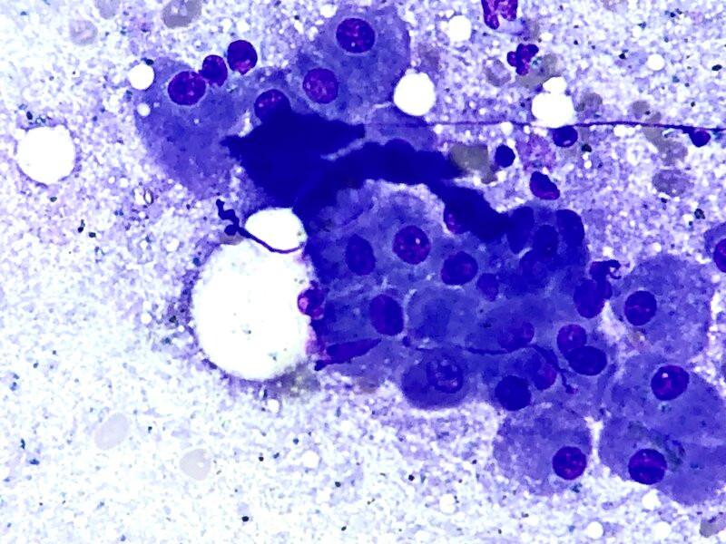 Figura 1C. Célula de alto adyacente a grupo de hepatocitos.