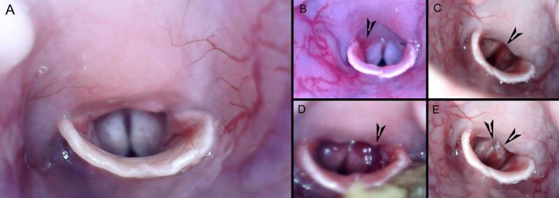 Figura 2. (A). Visualización endoscópia de una glotis de conejo sano ppreviaa la intubación. (B) Se observa eritemia en la glotis (punta de flecha) tras un intento de intubación. (C-D) Se aprecia hemorragia alrededor de la glotis (C, punta de flecha) y hematoma (D, punta de flecha) tras extubación. (E) Se observa edema (punta de flecha) de la glotis y laringospasmo tras varios intentos de intubación.