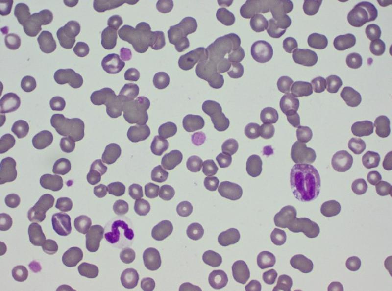 Figura 2. Agregación de glóbulos rojos en un perro con anemia hemolítica inmunomediada, con eritrocitos macrocíticos y policromatófilos (imagen de regeneración).