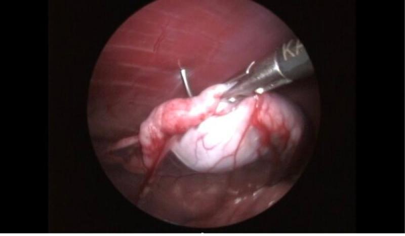 Figura 2. (B) Sujeción del testículo abdominal empleando gancho de ovariectomía.