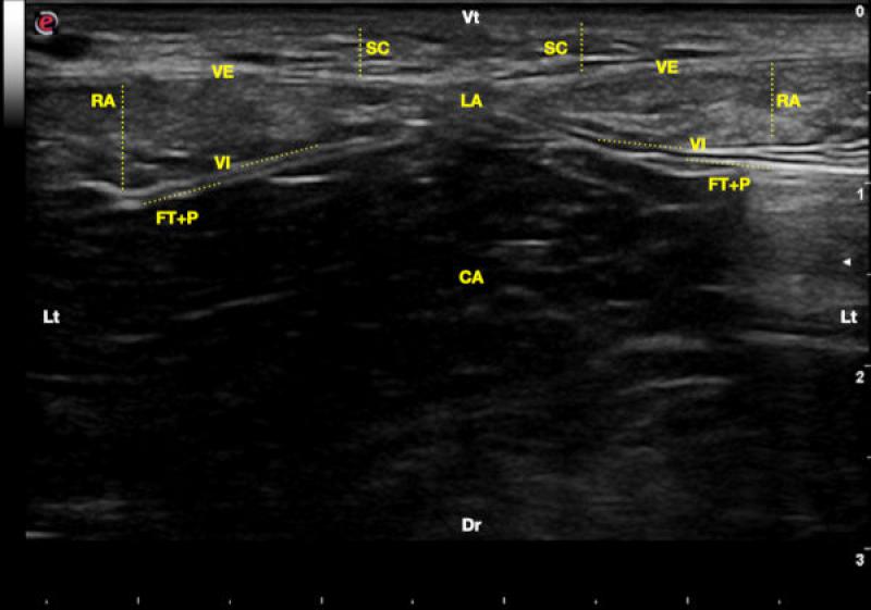 Figura 2. Corte transversal sobre la línea alba (LA) que facilita la visualización de los músculos rectos abdominales (RA). Se observa de ventral a dorsal el tejido subcutáneo (SC), la vaina externa del recto abdominal (VE), el vientre muscular del recto abdominal (RA), la vaina interna del recto abdominal (VI), la conjunción de la fascia transversalis (FM) y el peritoneo (P), y el interior de la cavidad abdominal (CA). Lateral (Lt), ventral (Vt) y dorsal (Dr).