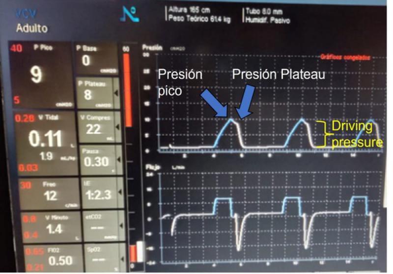 Figura 2: Curva Presión/Tiempo y Flujo/Tiempo en un paciente ventilado en modalidad volumen control. Las flechas señalan la presión máxima en la vía aérea (Presión pico) y la presión evaluada luego del empleo de una pausa inspiratoria (Presión plateau). La driving pressure (llave amarilla) representa el valor de presión plateau por encima de la PEEP (presión positiva al final de la espiración).
