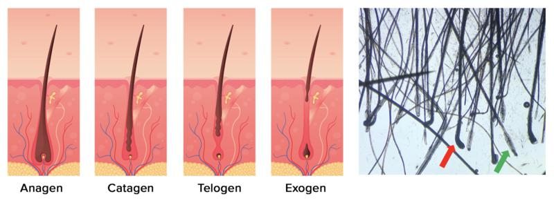 Figura 2: Diferentes fases del ciclo folicular (de: Grymowicz M, Rudnicka E, Podfigurna A, et al. Hormonal Effects on Hair Follicles. Int J Mol Sci 2020;21(15):5342). Aspecto microscópico de las raíces en diferentes fases. La flecha roja indica una raíz en fase de anagén; la verde, en fase de telogén.