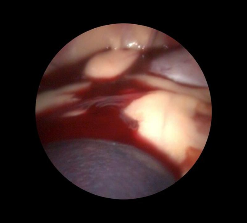Figura 2. El hemoperitoneo puede ser un hallazgo común durante la laparoscopia exploratoria en paciente con masa esplénicas.