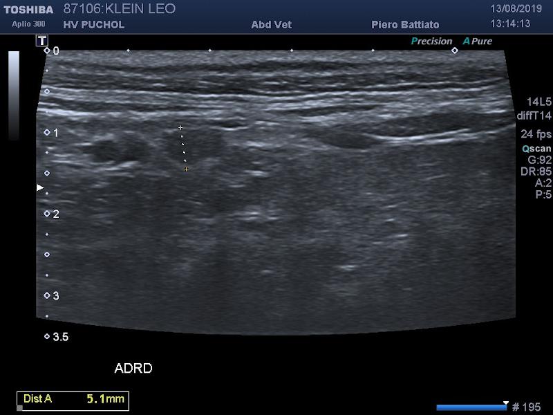 Figura 2. Imagen ecográfica de la glándula adrenal derecha ligeramente aumentada de tamaño, probablemente debido a una hiperplasia nodular de la zona de la glomerulosa.