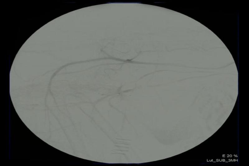 Figura 2: Imagen estática de la sustracción anterior, se puede observar el aumento de vasculatura a nivel de arteria prostática (fruto de la neovascularización neoplásica).