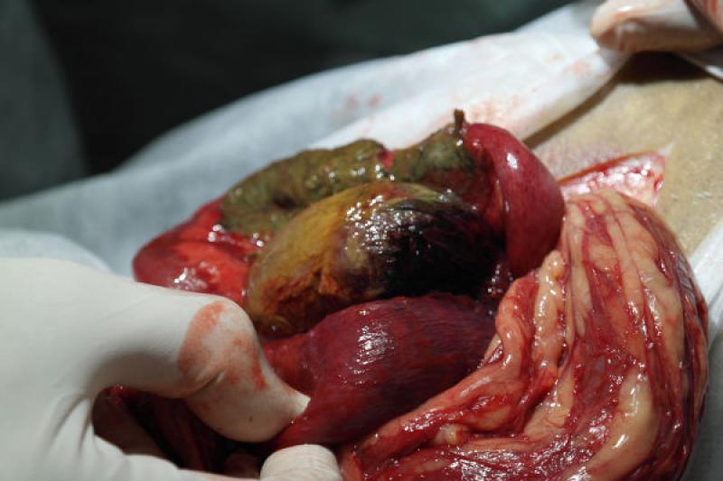 Figura 2: Paciente con traumatismo cerrado abdominal y shock traumático. Lesión vascular por trauma, con porción de intestino delgado desvitalizado y riesgo de lesión contaminante peritoneal.