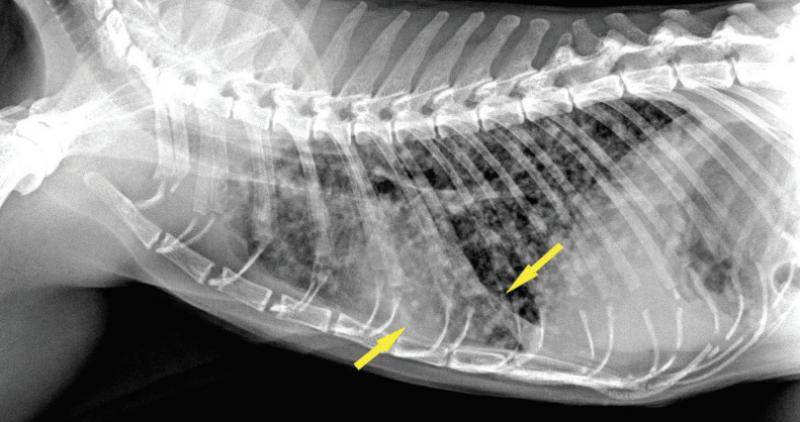 Figura 2. Radiografía pulmonar del paciente en la que se observan fisuras interlobulares (flechas).