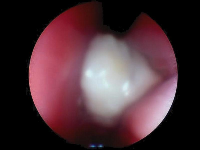 Figura 2: Rinoscopia meato derecho, se observa una neoformación de superficie rugosa y color blanquecino. Mucosa hiperémica.