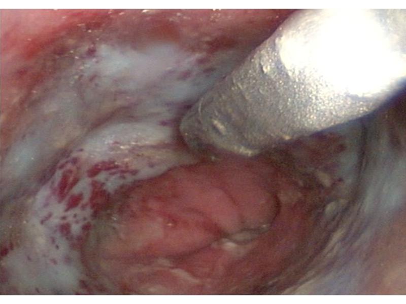 Figura 2. Severa esofagitis secundaria a la impactación de cuerpo extraño craneal al esfínter del cardias.