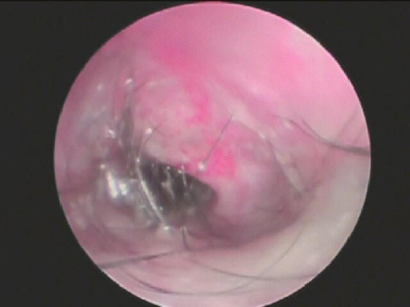 Figura 21. Pars flacida de membrana timpánica engrosada, debido a cuadro de OE crónico, aspecto después del lavado auricular profundo.