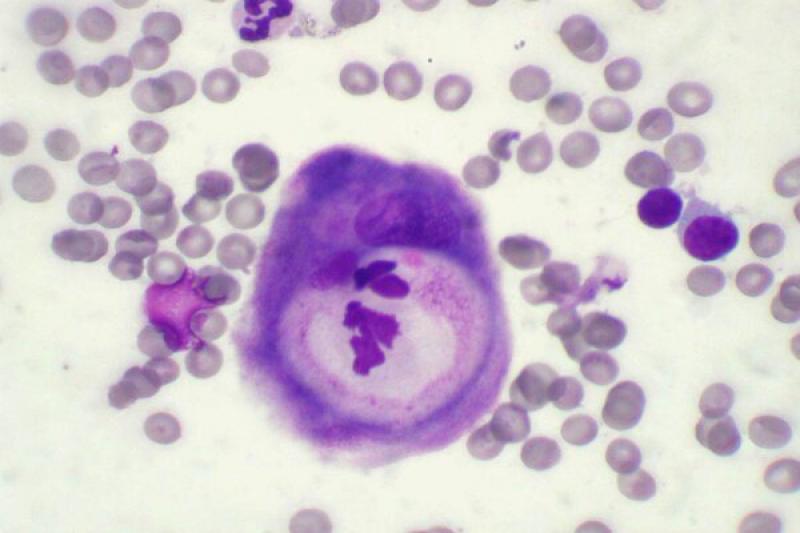 Figura 27. Carcinoma de células escamosas.