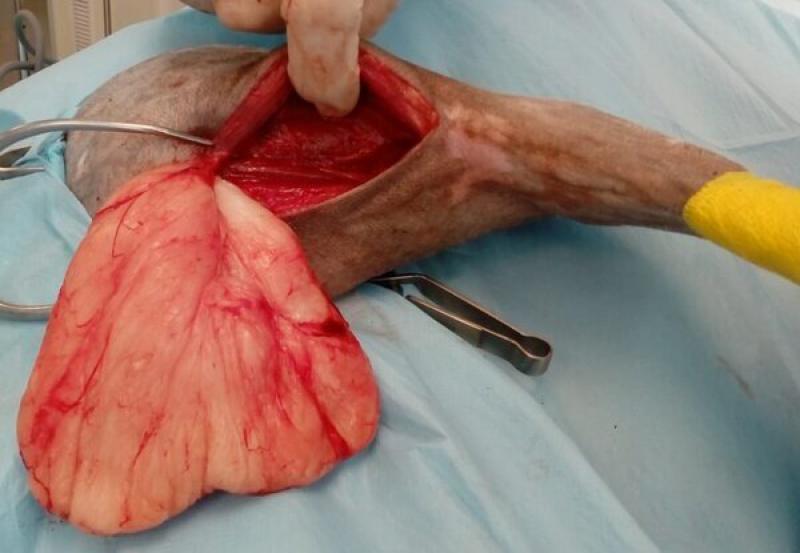 Figura 2b: Cirugía marginal en un lipoma intermuscular en la extremidad posterior. Se ha realizado la escisión inmediatamente alrededor del tumor, sin incluir tejido sano en la resección.