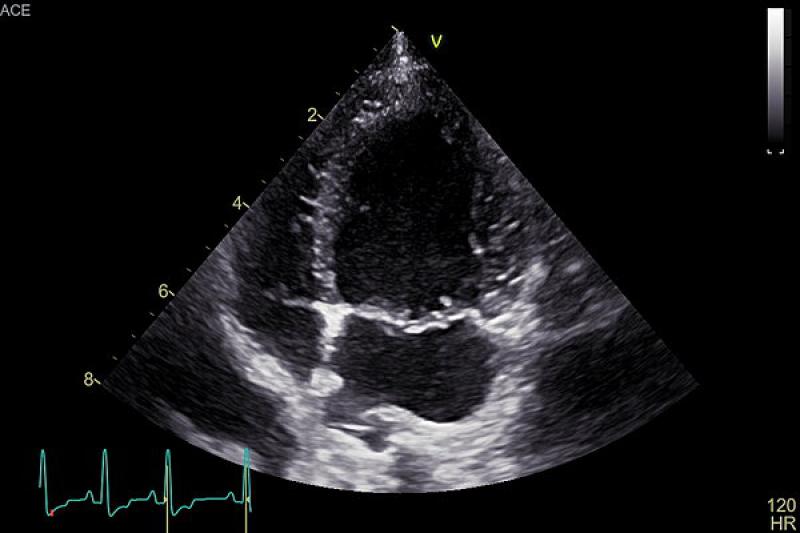 Figura 2B. Ecocardiografía: engrosamiento y aumento de la ecogenicidad de la válvula mitral. a. Vista parasternal derecha eje largo 4 cámaras. b. Vista apical izquierda de 4 cámaras