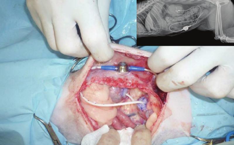 Figura 2B. Paciente sometido a cirugía de colocación de bypass ureteral subcutáneo para la resolución de obstrucción ureteral crónica y radiografia del mismo paciente tras la cirugía.