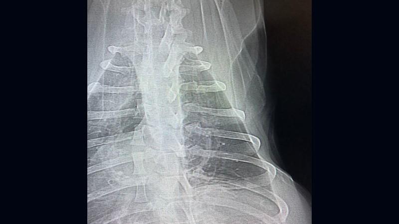 Figura 2B. Radiografia de tórax.