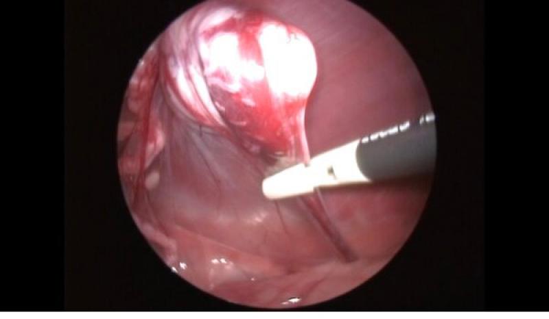 Figura 3. (A) Coagulación y corte de la arteria y vena testicular.