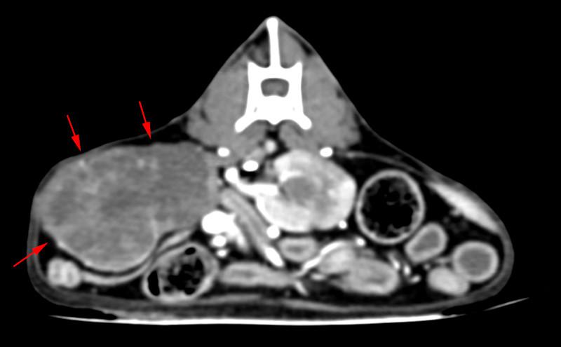 Figura 3. Carcinoma renal (flechas rojas). Las pruebas de diagnóstico por imagen son claves no solo a nivel quirúrgico, si no para el estudio de la génesis nociceptiva y la correcta planificación quirúrgica. Cortesía de Pierantonio Battiato.