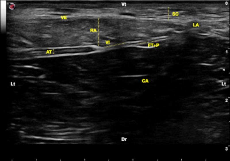Figura 3. Corte transversal sobre el músculo recto abdominal (RA). Se observa de ventral a dorsal el tejido subcutáneo (SC), la vaina externa del recto abdominal (VE), el vientre muscular del recto abdominal (RA), la vaina interna del recto abdominal (VI), el músculo abdominal transverso (AT), la conjunción de la fascia transversalis (FM) y el peritoneo (P), y el interior de la cavidad abdominal (CA). Línea alba (LA), lateral (Lt), ventral (Vt) y dorsal (Dr).