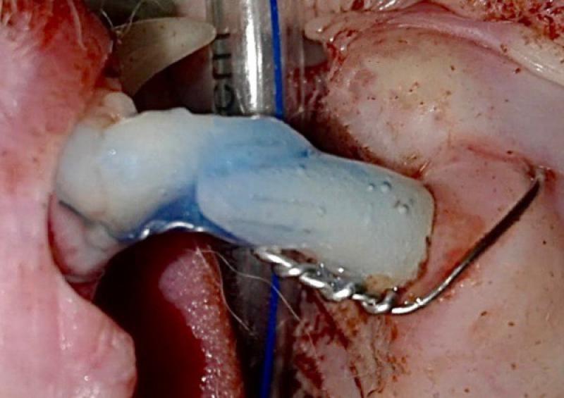 Figura 3. (D) Se rodea la sínfisis mandibular introduciendo un extremo del alambre tunelizando con aguja a través de la mucosa mesial de los insisivos inferiores para luego retornar a la zona inicial uniéndose con el resto de la fusión. En la imagen puede observarse el grabado con ácido ortofosfórico al 37 % en gel.