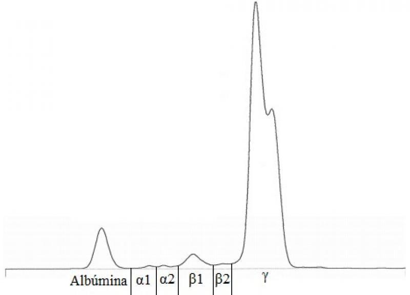 Figura 3. Electroforesis de proteínas séricas en el paciente, con un pico monoclonal en gamma.