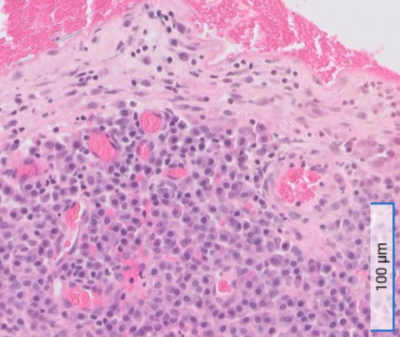 Figura 3: Examen histológico. Visualización de las células. Tienen un citoplasma basófilo abundante con una zona blanca perinuclear que corresponde al aparato de Golgi, o arcoplasma, y que permite identificar estas células como células plasmáticas.