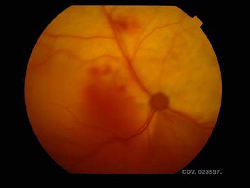 Figura 3. Fondo de ojo de un gato presentado a consulta debido a ceguera de aparición aguda que muestra una coroidopatía hipertensiva con desprendimiento de retina y hemorragias debido a hipertensión arterial severa.