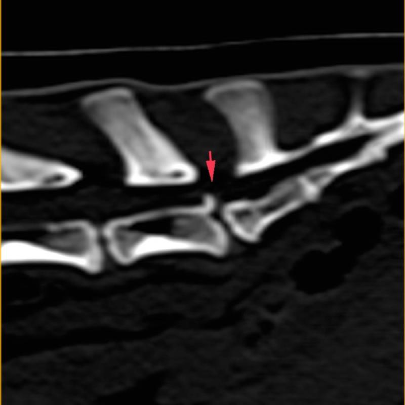 Figura 3. Fractura vertebral debida a un mal manejo. Imágenes tomadas mediante Tomografía Axial Computarizada.