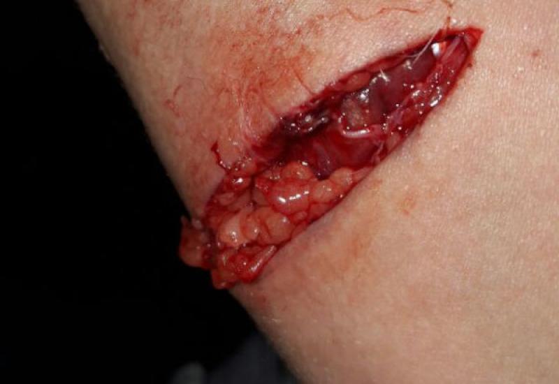 Figura 3. Herida ocasionada por agresión explosiva de un perro a su dueña.