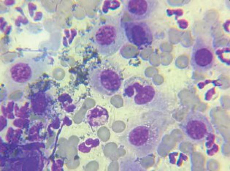 Figura 3. Imagen de la PAF de la lesión en la que se observan células epiteliales y abundantes neutrófilos.