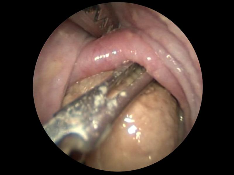 Figura 3. Imagen endoscópica de la maniobra de desimpactación de cuerpo extraño a nivel esofágico mediante el empleo de endoscopio rígido y dos pinzas rígidas en paralelo.