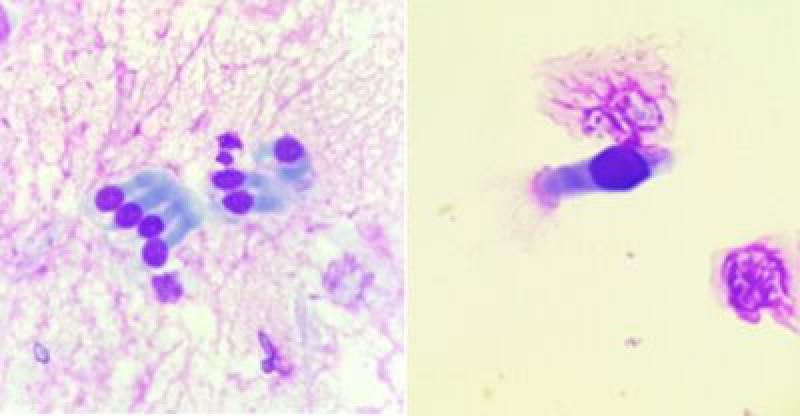 Figura 3. Imagen microscópica (x100). En la imagen de la izquierda observarnos un conjunto de células respiratorias columnares ciliadas en las cuales no se aprecian los cilios. A la derecha vamos una célula respiratoria con cilios visibles.