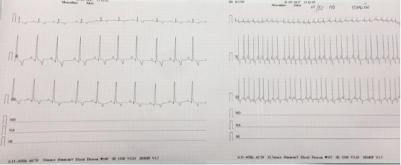 Figura 3. Registro ECG de un mismo paciente: izquierda a una velocidad de 50mm/s, derecha a una velocidad de 12.5mm/s.