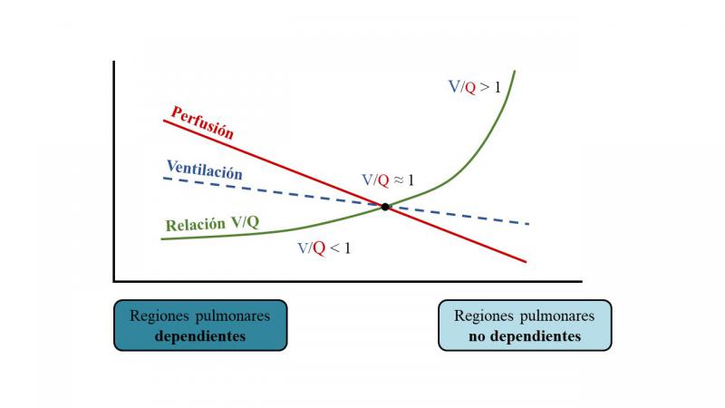 Figura 3. Representación esquemática de la distribución de la ventilación alveolar, la perfusión pulmonar y la relación entre la ventilación y la perfusión (V/Q) en el pulmón. La relación V/Q global del pulmón es de 0,8, pero esta relación varía dependiendo de la región: es mayor a medida que se avanza hacia las regiones pulmonares no dependientes (V/Q > 1), pero es menor a medida que se avanza hacia las regiones pulmonares dependientes (V/Q