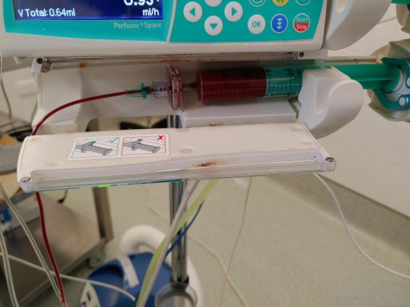 Figura 3. Transfusión de concentrado de glóbulos rojos mediante jeringa y perfusor con un filtro en un paciente de pequeño tamaño.