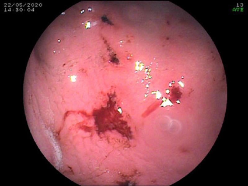 Figura 3. Úlcera digestiva asociada al uso prolongado y errático de inhibidores de la ciclooxigenasa.