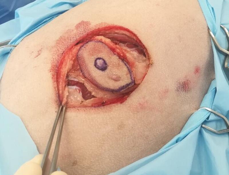 Figura 3a: Cirugía con márgenes amplios alrededor del tumor, incluyendo en la resección 3 cm laterales y un plano fascial en profundidad.