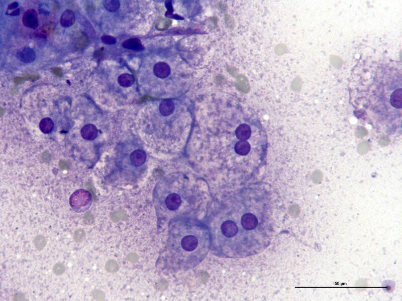 Figura 3A. Principales cambios degenerativos de los hepatocitos. Degeneración vacuolar no lipídica (rarefacción citoplasmática).
