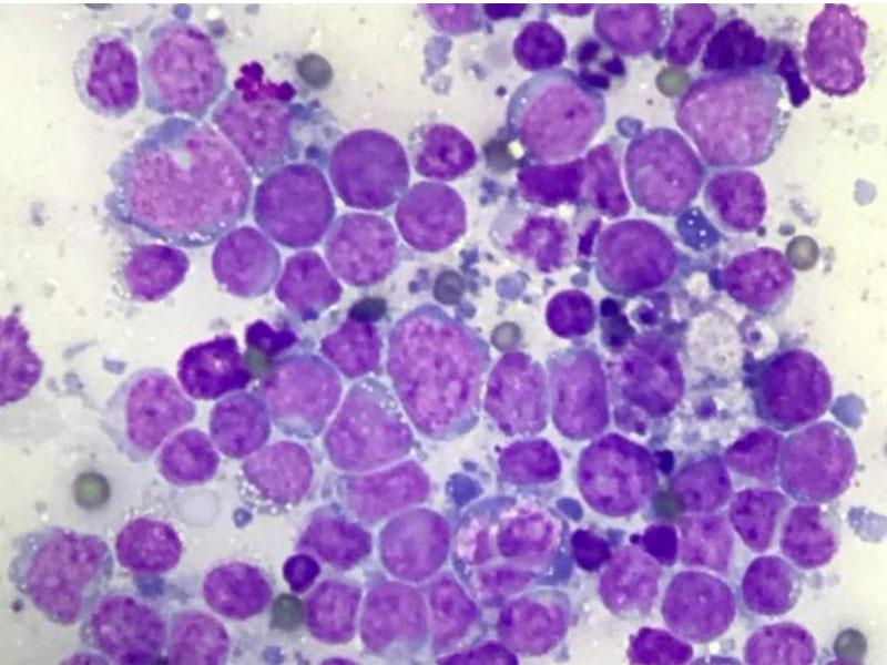 Figura 3.Imagen citológica de linfadenopatía yeyunal en un gatocompatible con linfoma de alto grado (mayoría de linfocitos grandes). Imagen cedida por Víctor Domingo, Atypia.