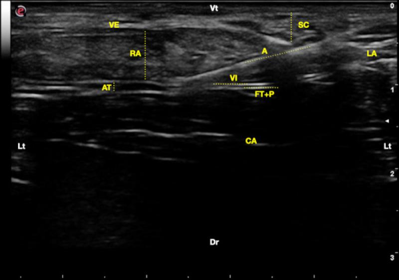 Figura 4. Abordaje ?en plano? para el bloqueo de la vaina del recto abdominal. Se observa la aguja (A) penetrando de ventro-medial a dorsal-lateral, atravesando el tejido subcutáneo (SC), la vaina externa del recto abdominal (VE), el vientre muscular del recto abdominal (RA), situando la punta de la aguja entre el epimisio interior del músculo recto abdominal (RA) y la vaina interna del recto abdominal (VI). También se observan el músculo abdominal transverso (AT), la conjunción de la fascia transversalis (FM) y el peritoneo (P), y el interior de la cavidad abdominal (CA). Línea alba (LA), lateral (Lt), ventral (Vt) y dorsal (Dr).