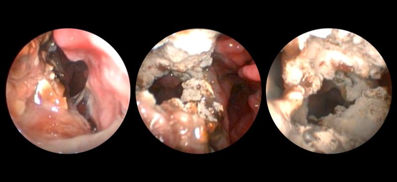 Figura 4. Aspecto endoscópico característico de las rinitis fúngicas, asociada a la existencia de destrucción de la anatomía nasal asociado a la presencia de colonias y a granulomas fúngicos.