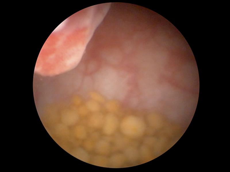 Figura 4: Aspecto endoscópico de pólipo vesical inflamatorio secundario a urolitiasis.