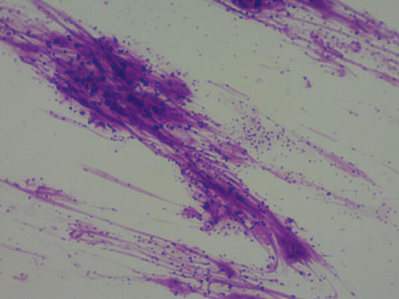 Figura 4. Citología de la lesión con neutrofilia y bacterias coccoides intracelulares.