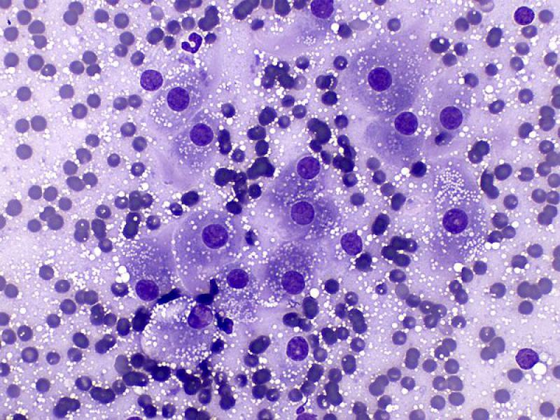Figura 4. Citología de tumor testicular de células intersticiales. Las células muestran apariencia de células endocrinas productoras de esteroides. Tinción de tipo Romanowsky, objetivo 40x.