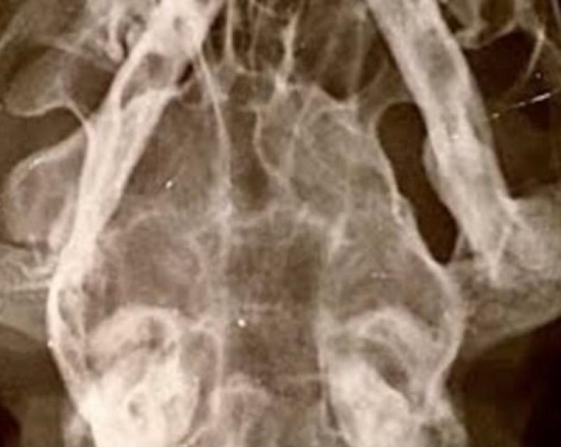 Figura 4. (E) Anquilosis mandibular evidente en la radiografia de cráneo 5 meses posterior a la fractura original en la zona de la ATM.