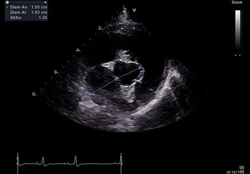 Figura 4. Ecocardiografía: relación atrio izquierdo/aorta (1,25) en la vista de eje corto parasternal derecha a nivel de la base cardíaca.
