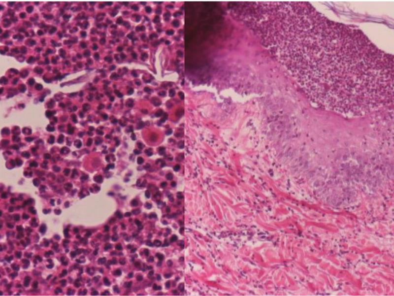 Figura 4. Imagen histopatológica de un paciente con pénfigo foliáceo. Se observa hiperplasia epidérmica con presencia de pústulas intracorneales y subcorneales. El interior de las pústulas se encuentra formado por una población de neutrófilos no degenerados con presencia de abundantes células acantolíticas.