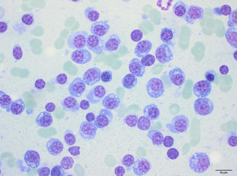 Figura 4. Imagen representativa de la citología de médula ósea del paciente, donde las células plasmáticas componen más del 50 % del total de células nucleadas.