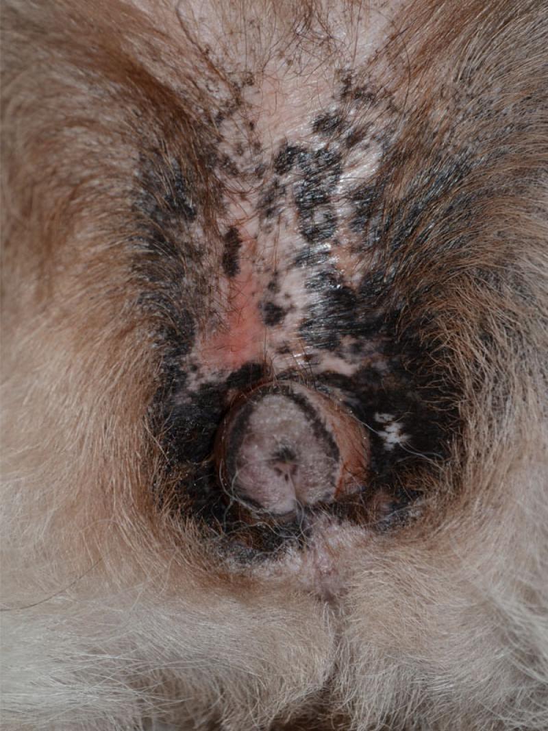 Figura 4: Lupus eritematoso crónico cutáneo, forma mucocutánea. Lesiones erosivas y ulcerativas con despigmentación central e hiperpigmentación periférica en las regiones mucocutáneas de la vulva