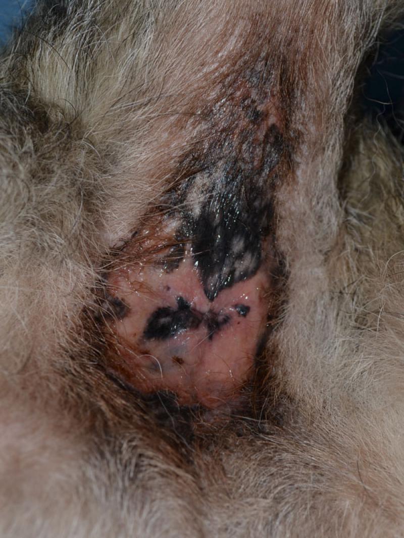 Figura 4: Lupus eritematoso crónico cutáneo, forma mucocutánea. Lesiones erosivas y ulcerativas con despigmentación central e hiperpigmentación periférica en las regiones mucocutáneas del ano.